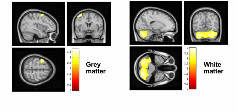 The Association between Lifelong Greenspace Exposure and 3-Dimensional Brain Magnetic Resonance Imaging in Barcelona Schoolchildren
